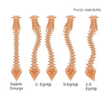 Skolyoz Çeşitleri Skolyoz ve Farklı omurga bilgileri